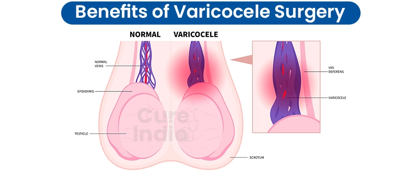 Benefits of Getting Varicocele Surgery in India